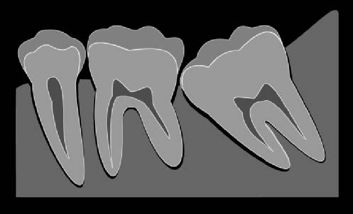 歯のレントゲン写真イメージ